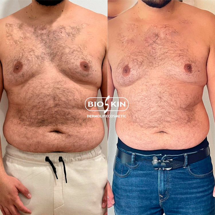 کوکتل قوی لاغری ( چربی سوزی شکم و پهلو ) برند بایو اسکین Bioskin lipopro ده سی سی
