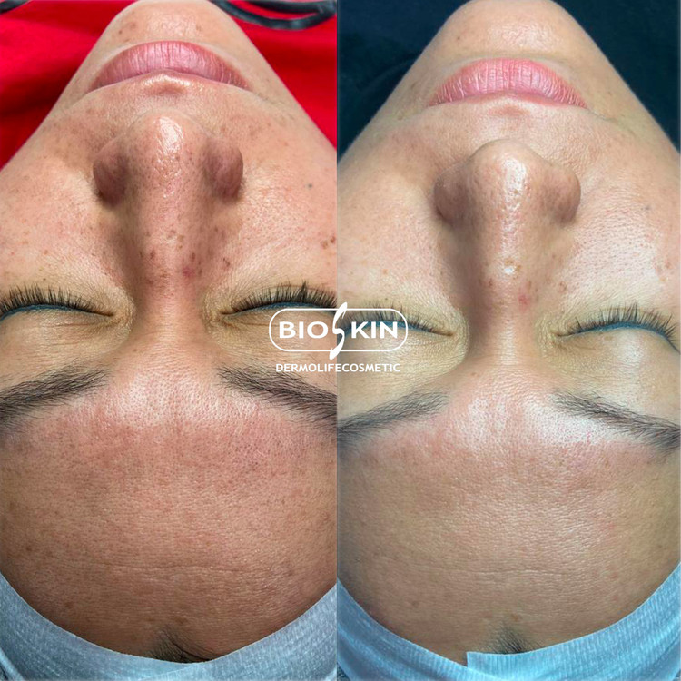 مزو کوکتل بایو اسکین ضدلک روشن کننده و ضد ملاسما Bioskin Bright pro ده سی سی . جوانسازی آبرسانی